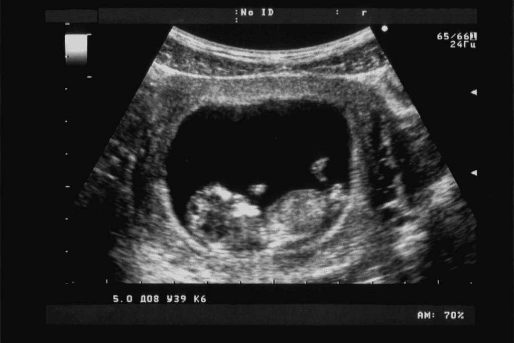 8 Week Embryo Ultrasound: What You See