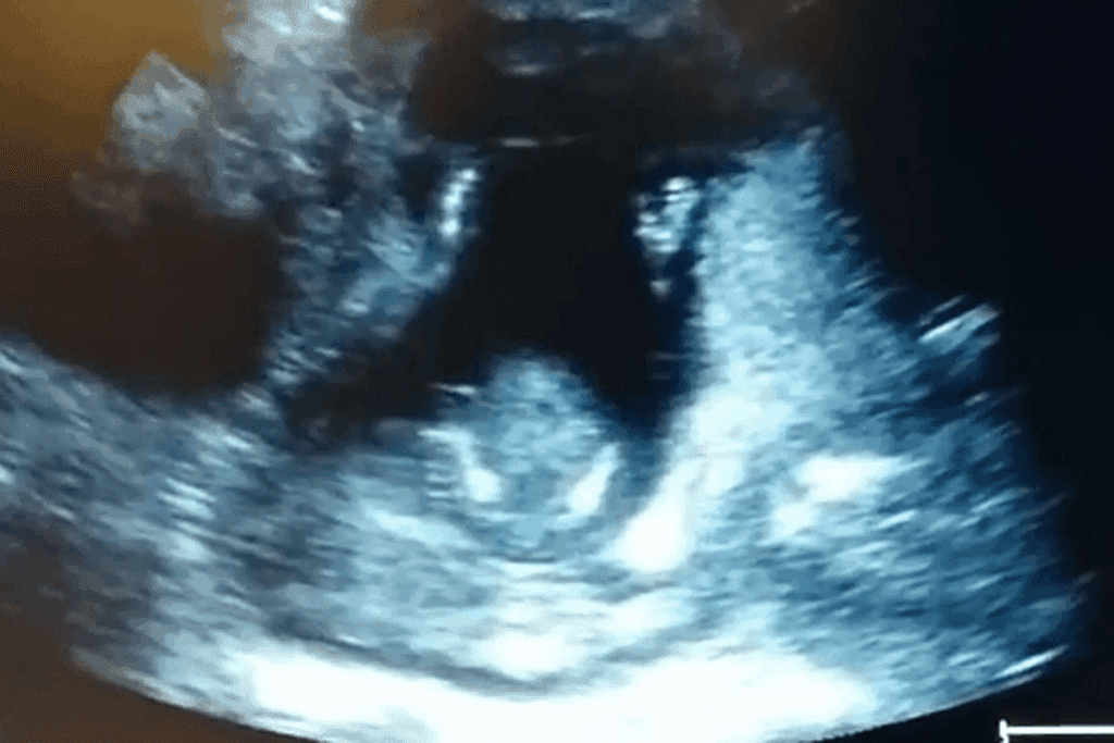 7 Weeks Transvag Ultrasound: What to Expect