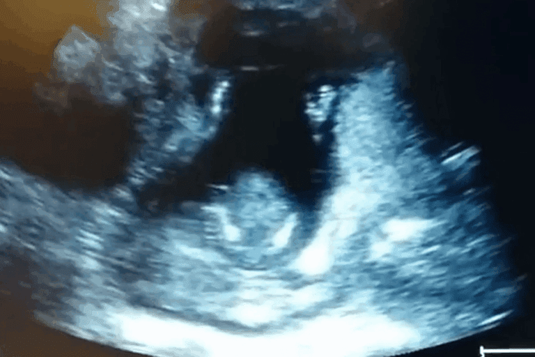 7 Weeks Transvag Ultrasound: What to Expect