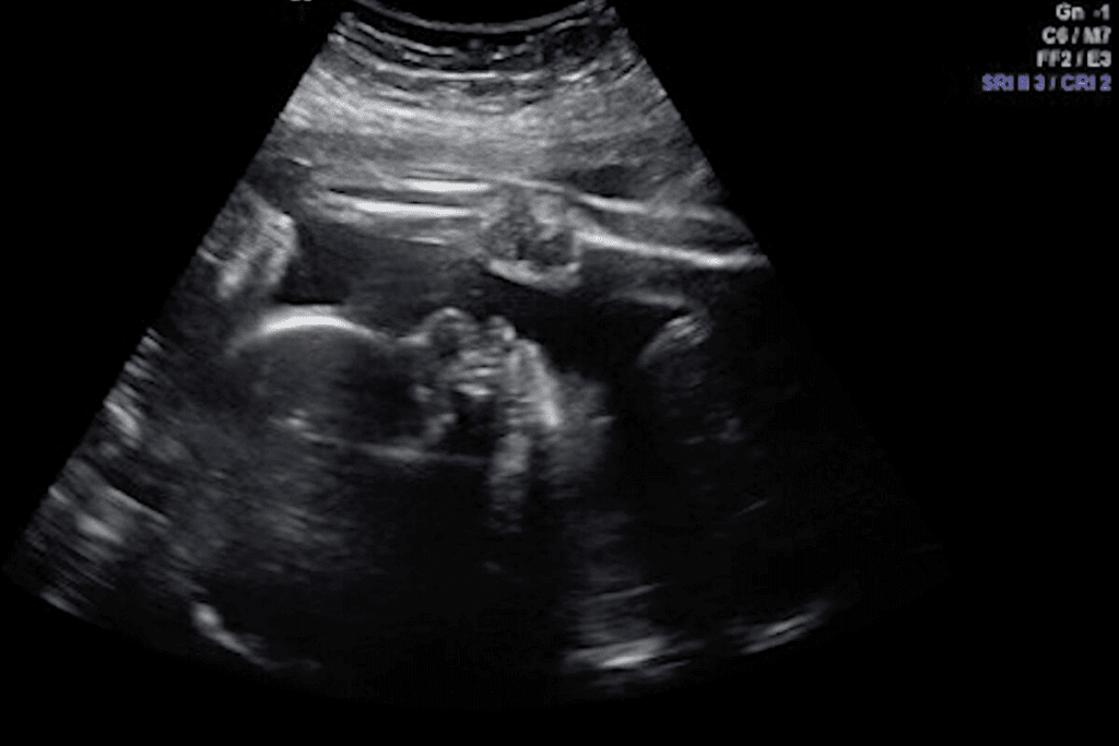 7 Weeks Pregnant Abdominal Ultrasound Look