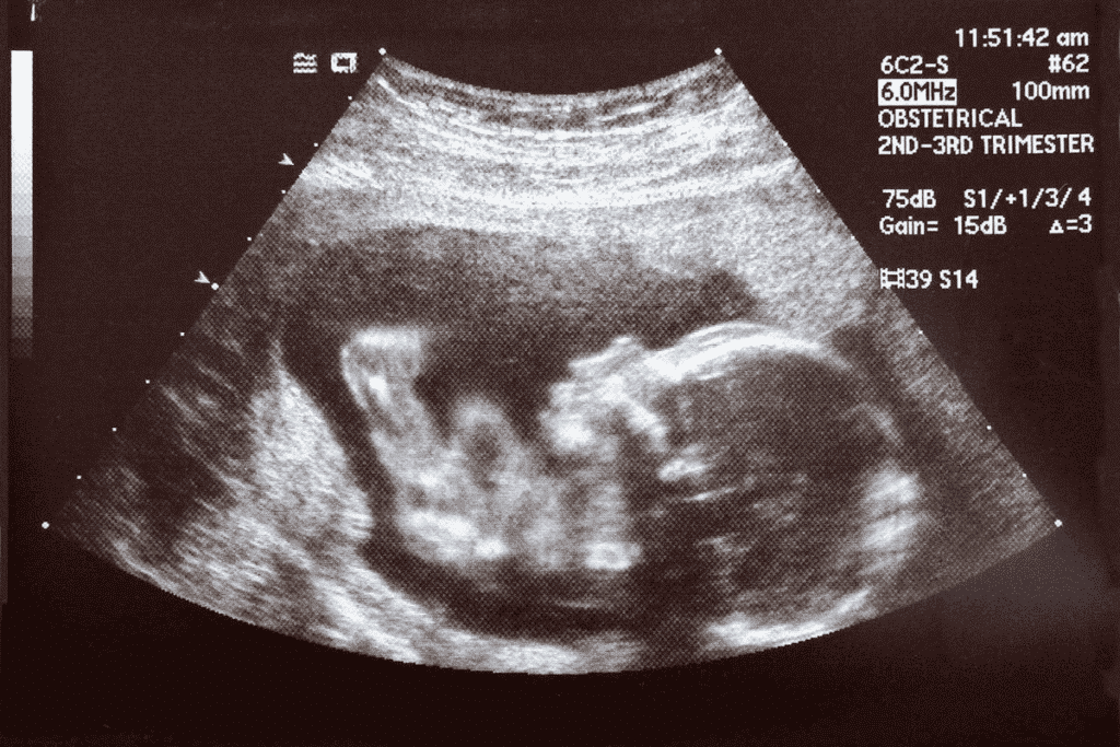 What Does a 7 Week Ultrasound Look Like?