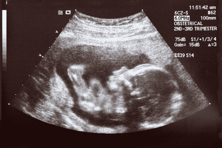 What Does a 7 Week Ultrasound Look Like?