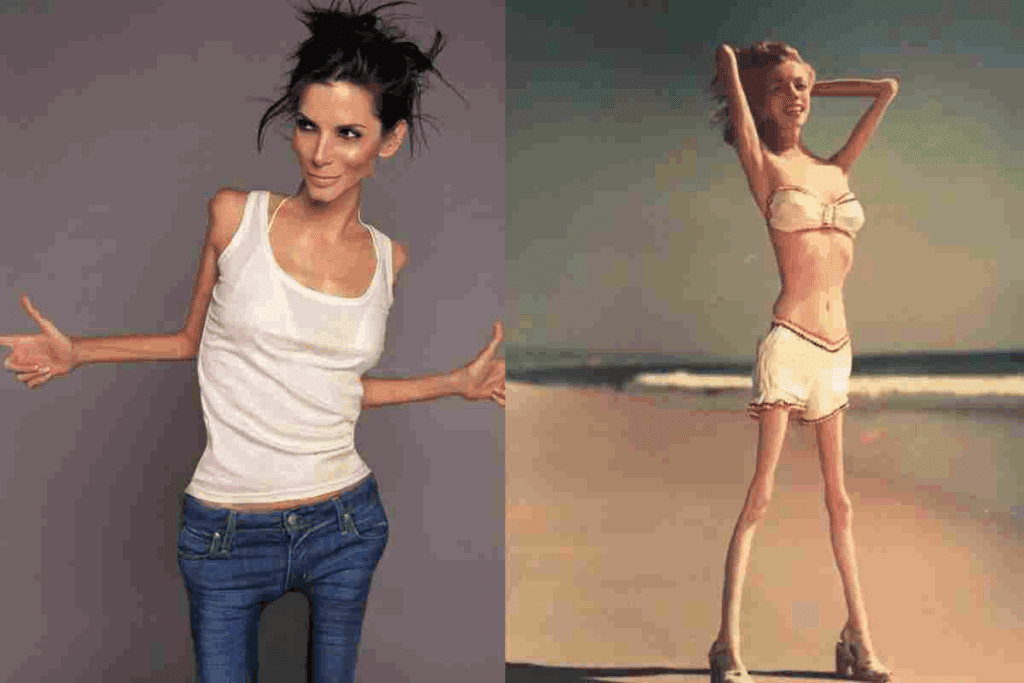 Atypical Anorexia: The Best Simple Guide