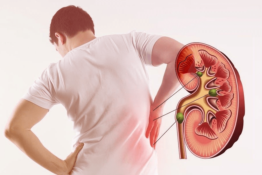Fourth Stage Kidney Disease: Best, Simple Guide