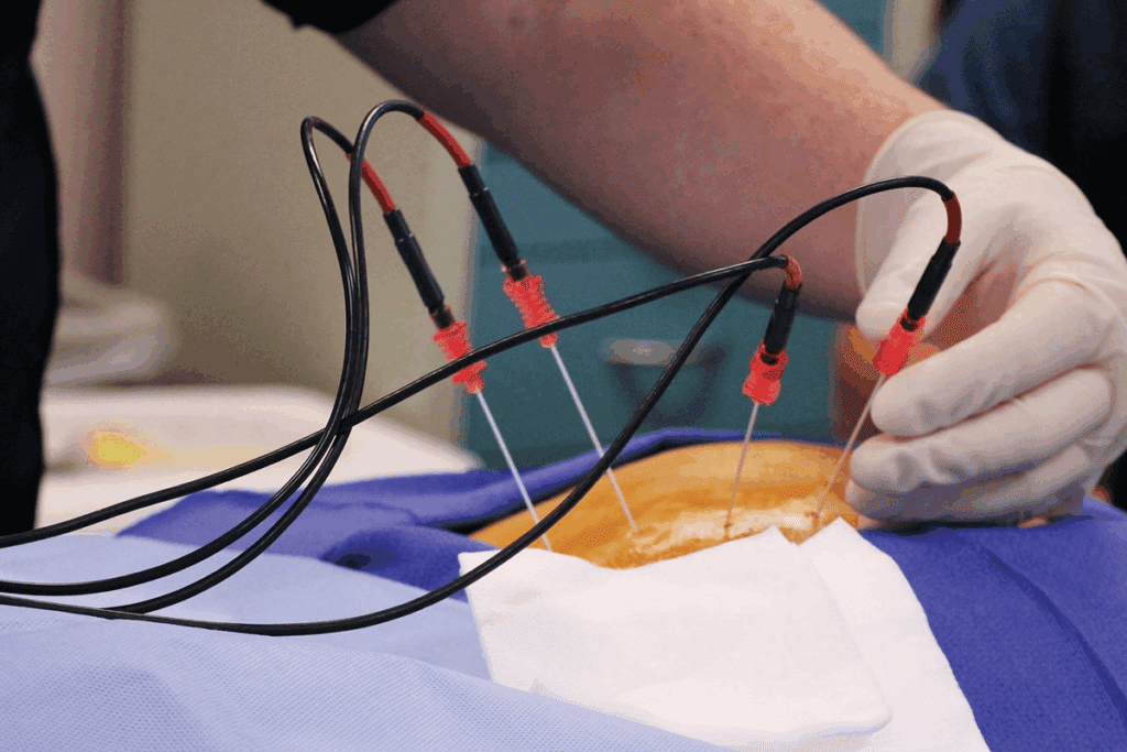 Radiofrequency Ablation: Is Sedation Required? 2 Radiofrequency Ablation: Is Sedation Required?