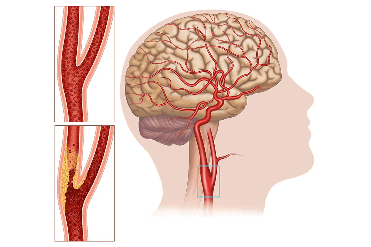 What Are The Odds Of Surviving Carotid Artery Surgery