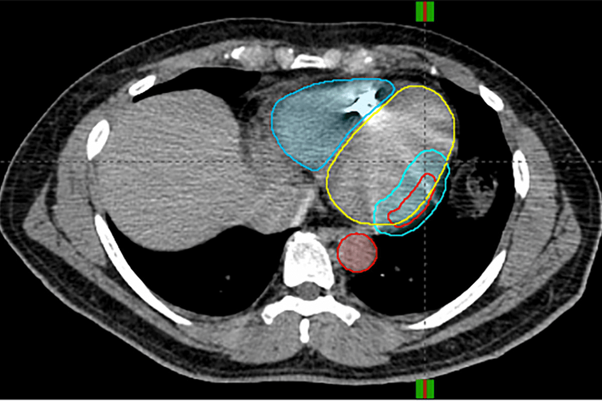 Define Gamma Knife Surgery Procedure