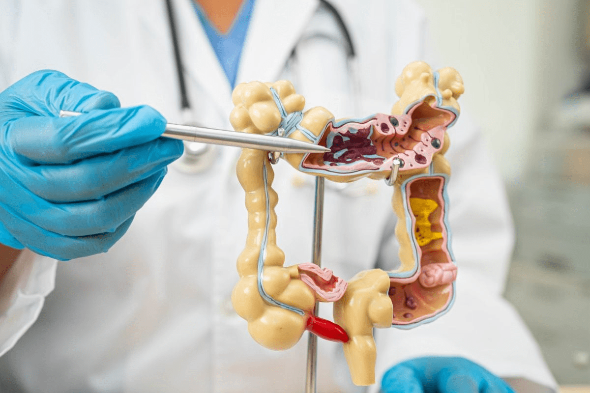 Small Bowel Resection: Your Ultimate Survival Guide