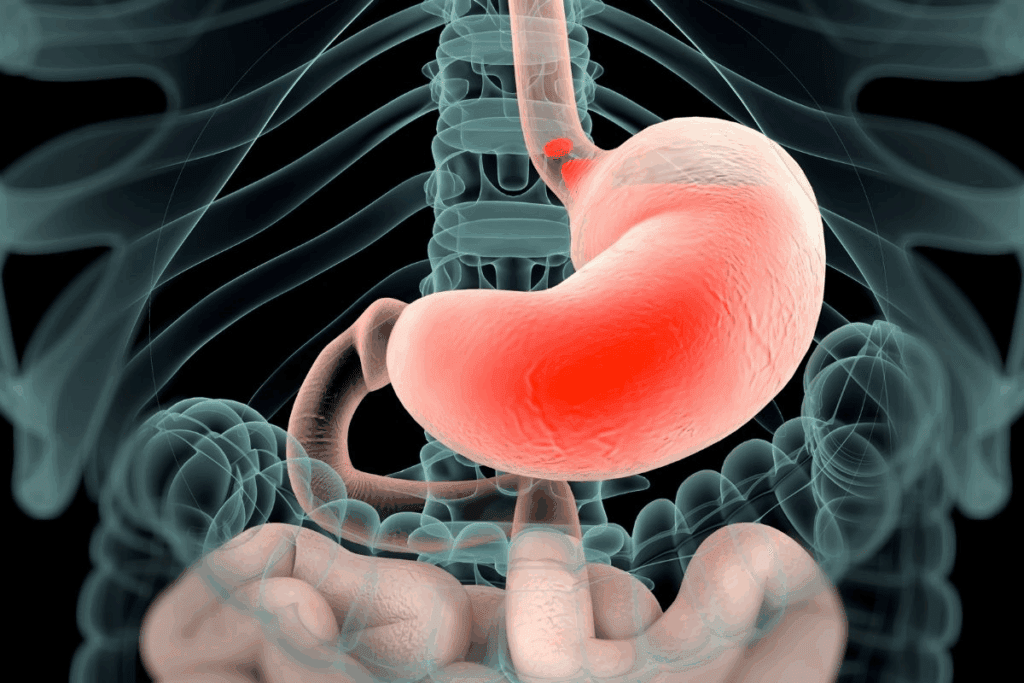 How to Cure GERD Permanently: The Surprising Truth