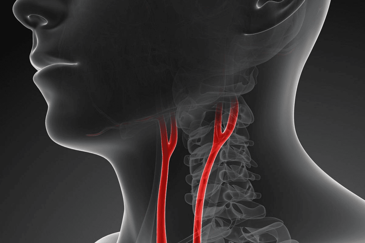 Can a carotid artery be cleared without surgery?