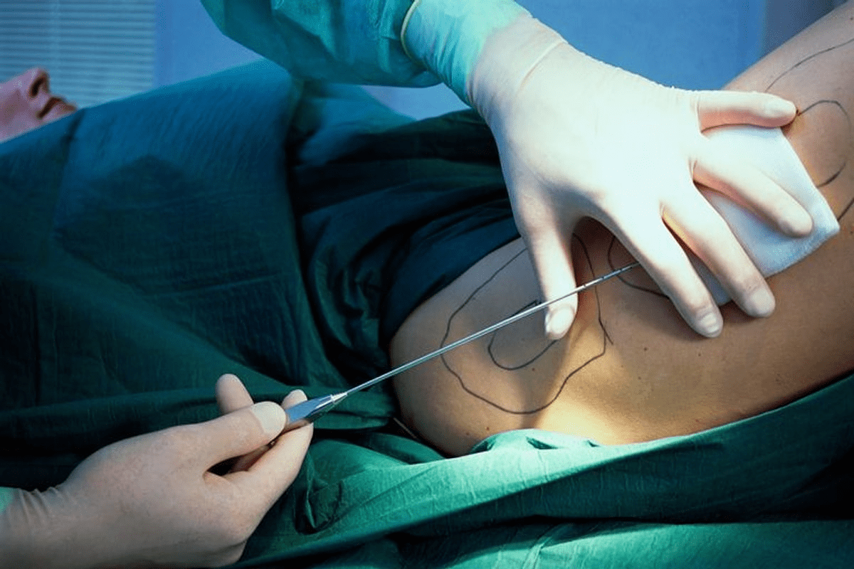 Lowest Survival Surgery: High-Risk Procedures