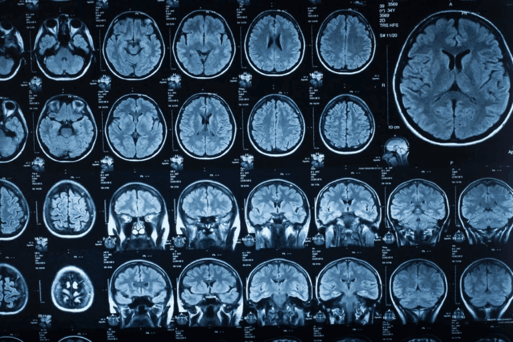 Crucial Disadvantages of Awake Brain Surgery 2 image 6729 LIV Hospital
