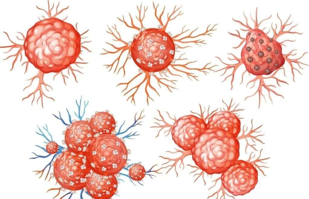 What Is the Difference Between Malignant and Benign Tumors? 2 image 49 LIV Hospital