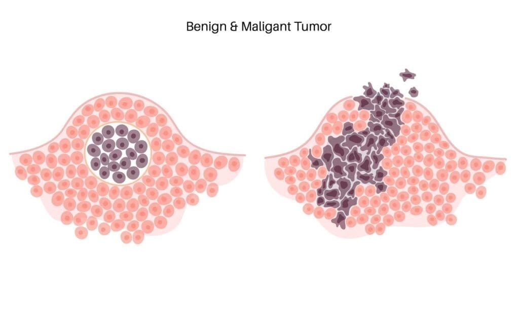 Malignant vs Benign Cancer: 8 Key Differences in Tumor Behavior