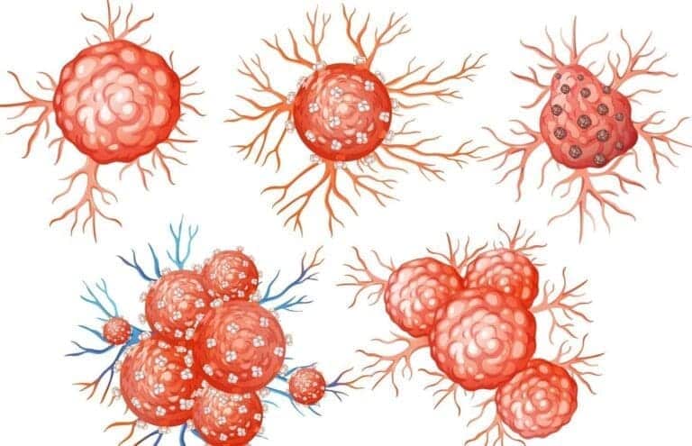 Benign Tumor Symptoms: 10 Common Signs, Causes, and Types Explained