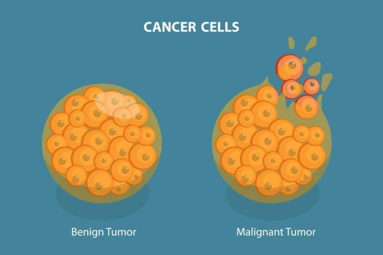 Benign vs Malignant Tumor: 8 Key Differences Explained