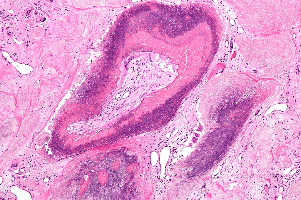 Essential Ovarian Cyst Pain Symptoms