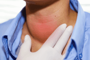 Define: Will Hyperthyroidism Cause Weight Gain?