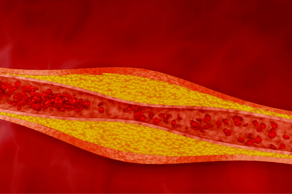 Crucial Abnormal Hardening Of The Walls Of An Artery Or Arteries