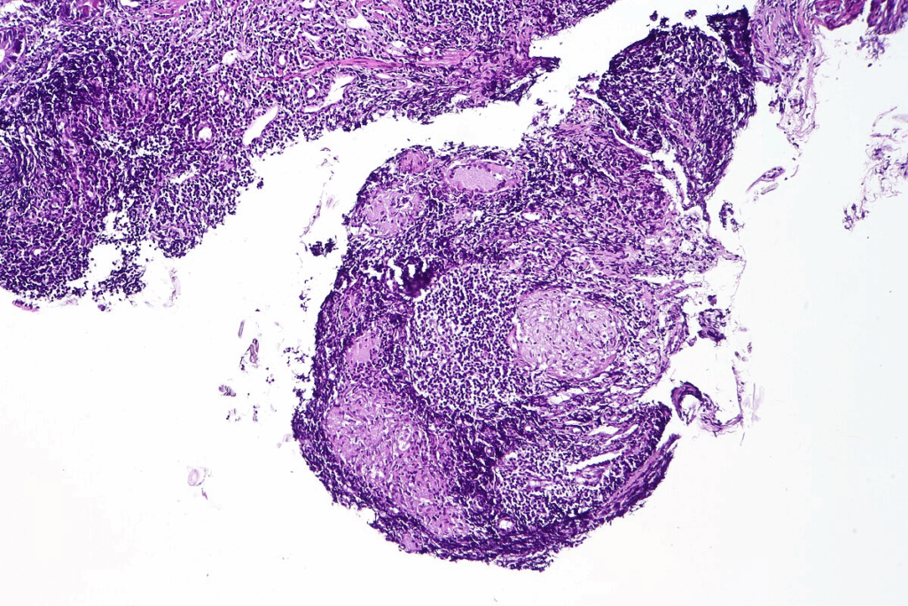 Tongue Fungus Autoimmune Disease: 5 Alarming Signs 1 Tongue Fungus Autoimmune Disease: 5 Alarming Signs