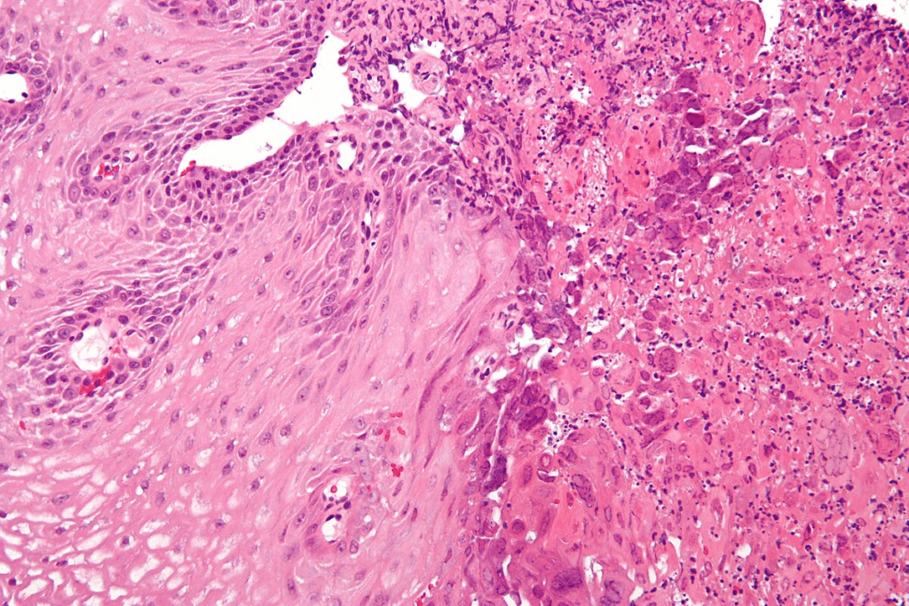 Oral Cancer Age: The Surprising Facts & Risks