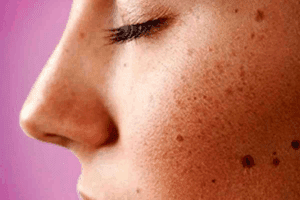 Dark Patches Inside Mouth: 7 Alarming Causes