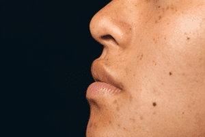 Mole Inside the Mouth: 5 Alarming Causes