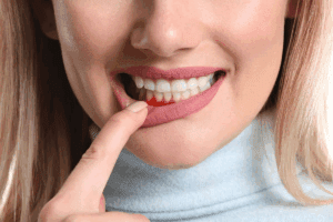 Blood Blister in Mouth Cancer: 5 Alarming Facts