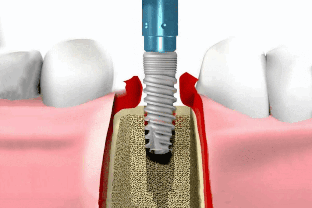 How Long Is the Process of Dental Implants? Key Facts