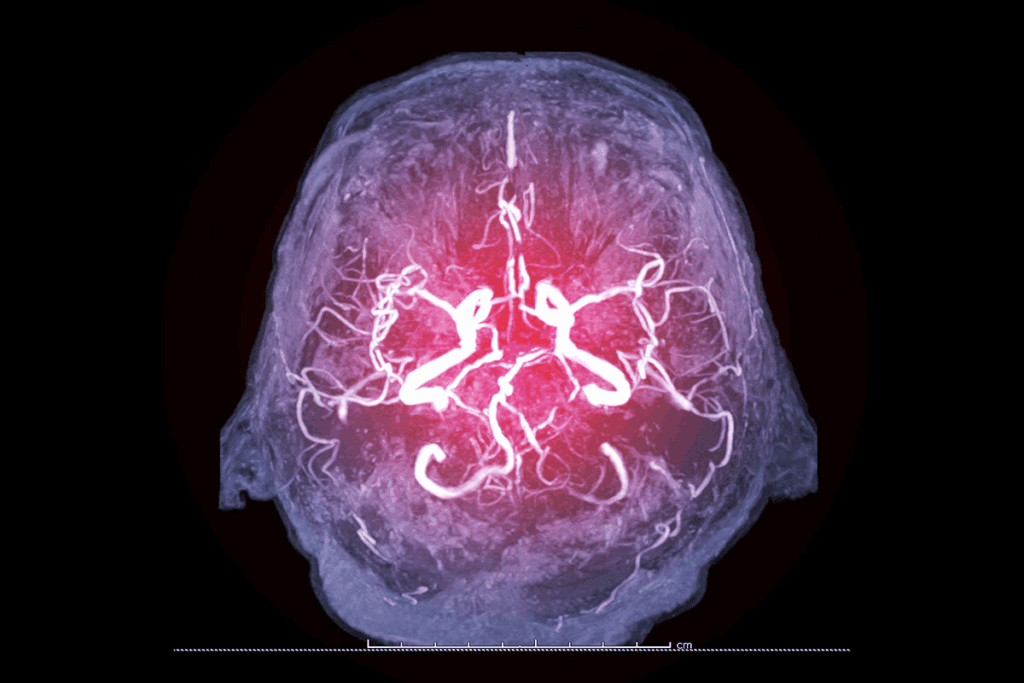 Cerebrovascular Diseases: The 4 Main Types Guide