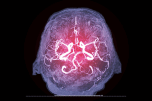 Cerebrovascular Diseases: The 4 Main Types Guide