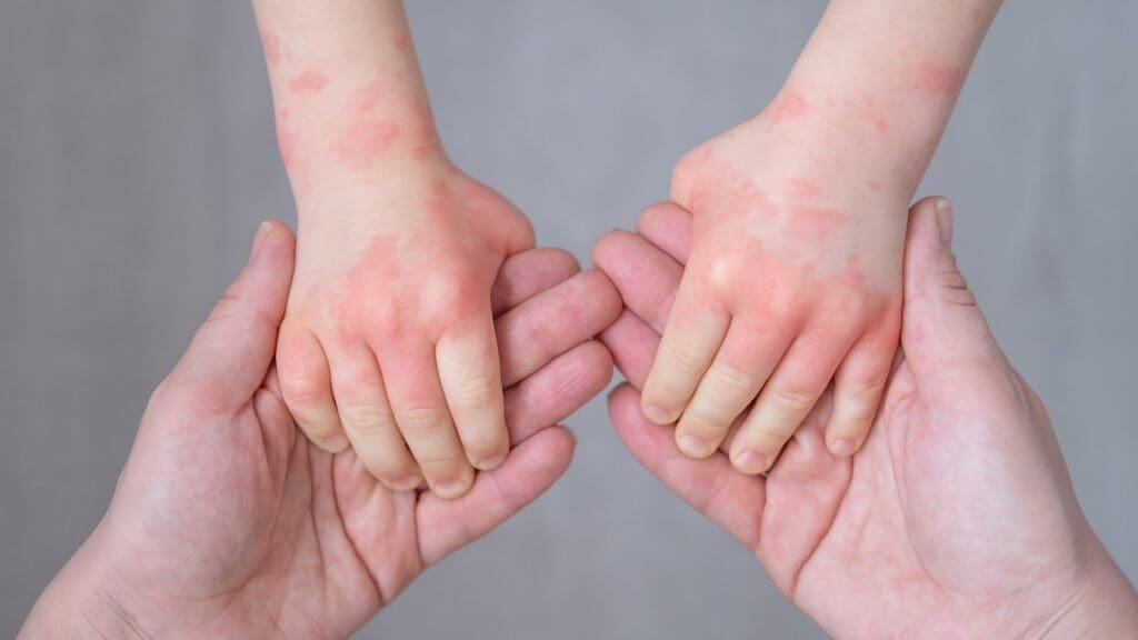 Spring Allergy in Children