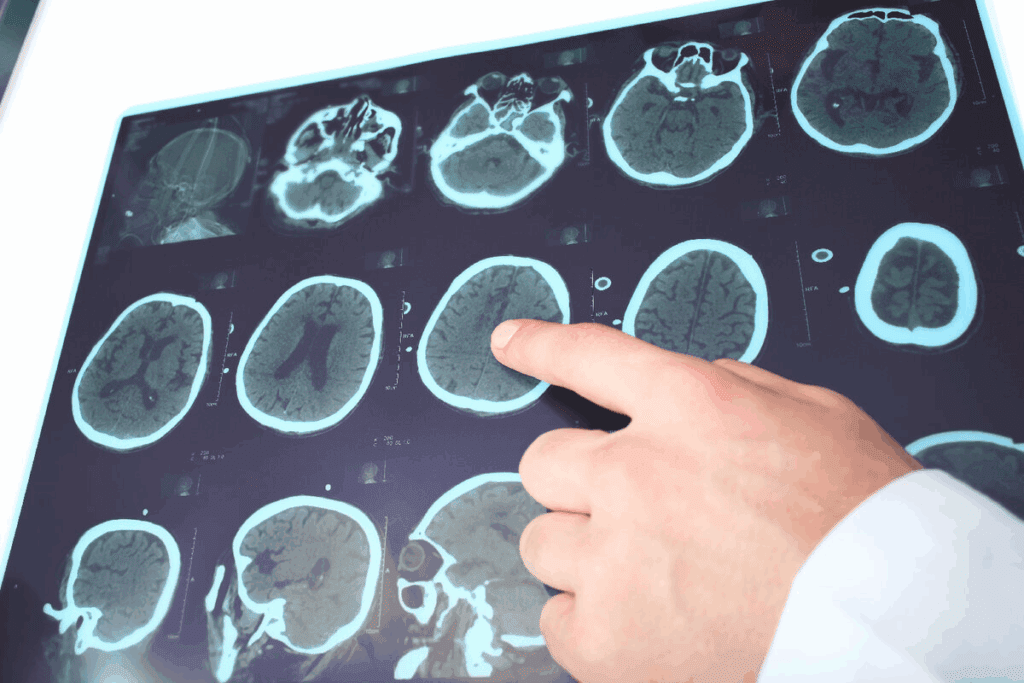 Do Seizures Cause Brain Damage?