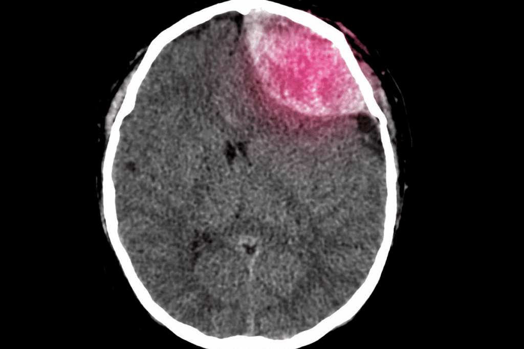 Skull replacement brain surgery: Amazing facts
