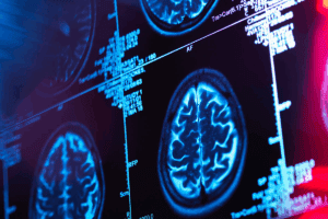 Neurosurgical recovery dynamics: An awful list