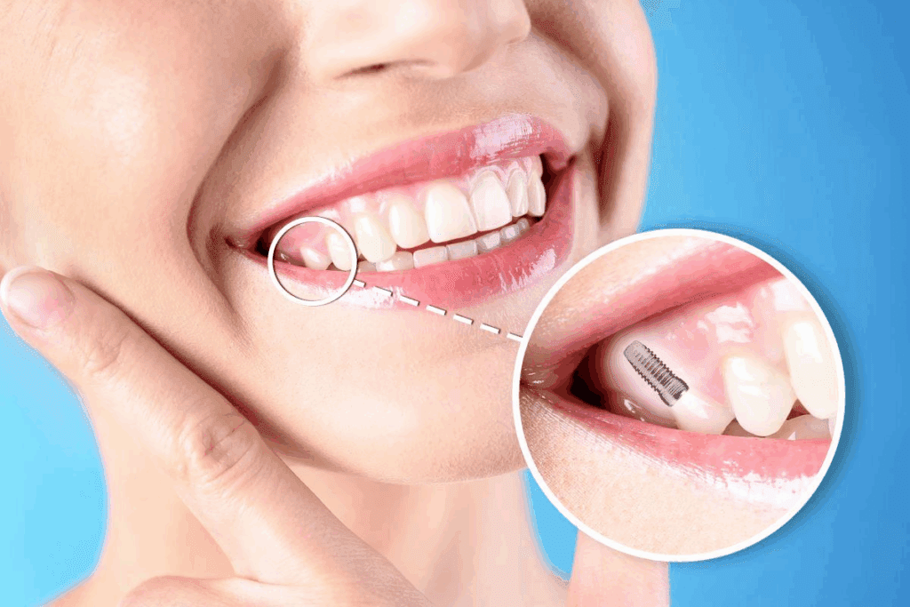 How to Get Full Upper Implants: A Complete Guide