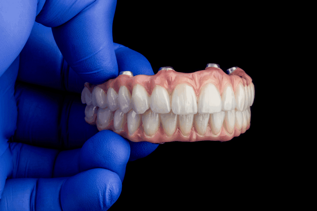 Before And After All On 4 Dental Implants: 15 Results