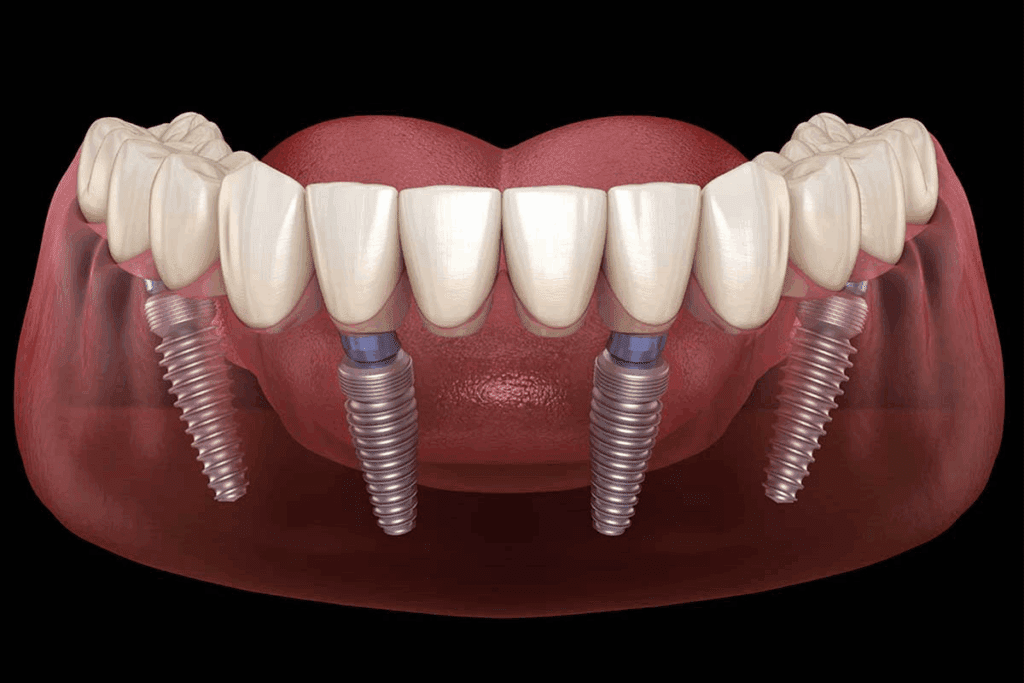 How To Get All On 4 Dental Implants: Complete Guide