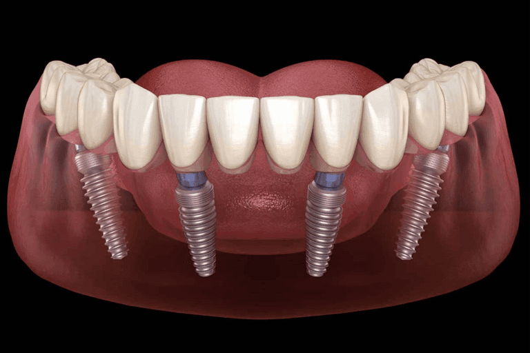 How To Get All On 4 Dental Implants: Complete Guide