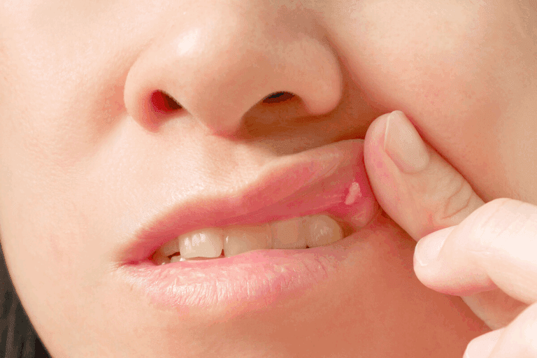 How To Identify Cancer On Roof Of Mouth: Signs And Symptoms