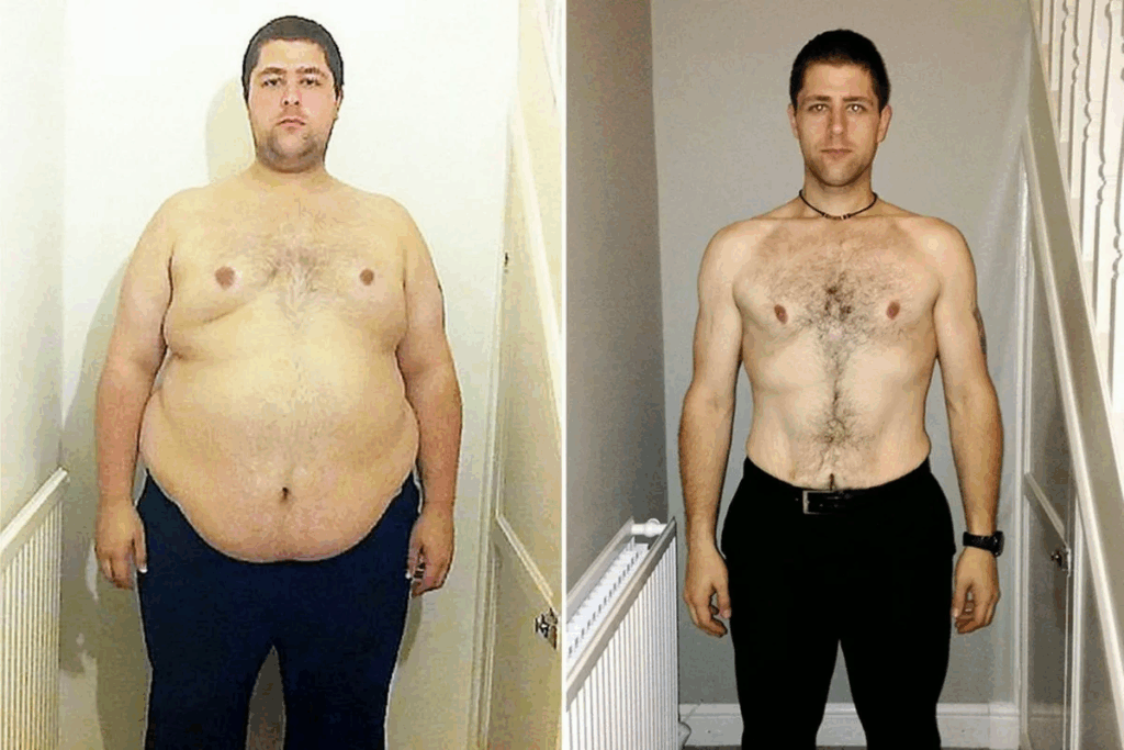 Managing Post Weight Loss Surgery Excess Skin