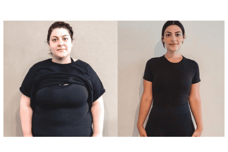 Managing Post Weight Loss Surgery Excess Skin