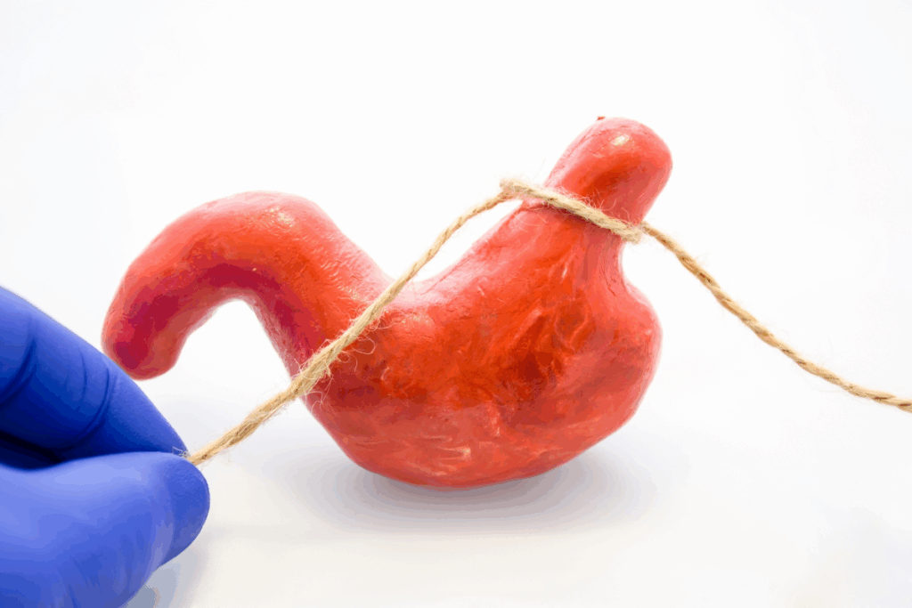 Understanding Gastric Sleeve Anatomy (Vsg)