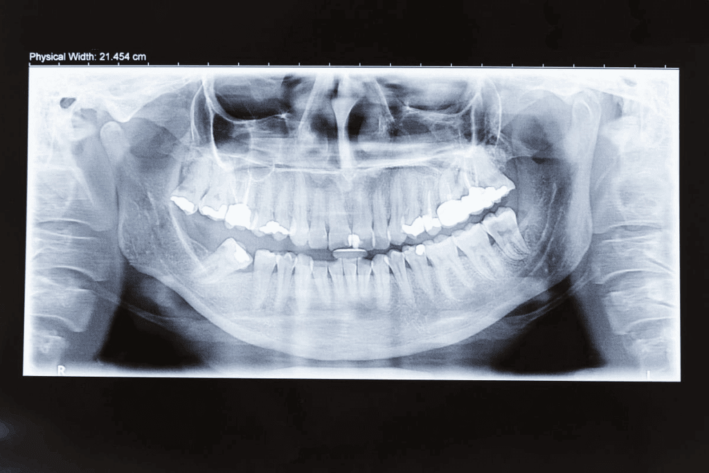 5 Benefits Of Dental Panoramic X-Rays