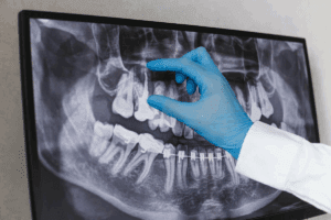 What Is A Panoramic Film Dental And How Does It Work?