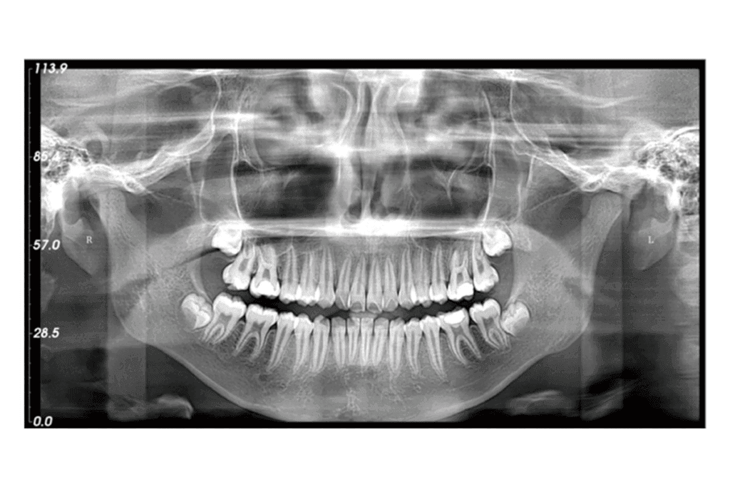 How Often Should You Get Digital Dental X Rays? ADA Guidelines