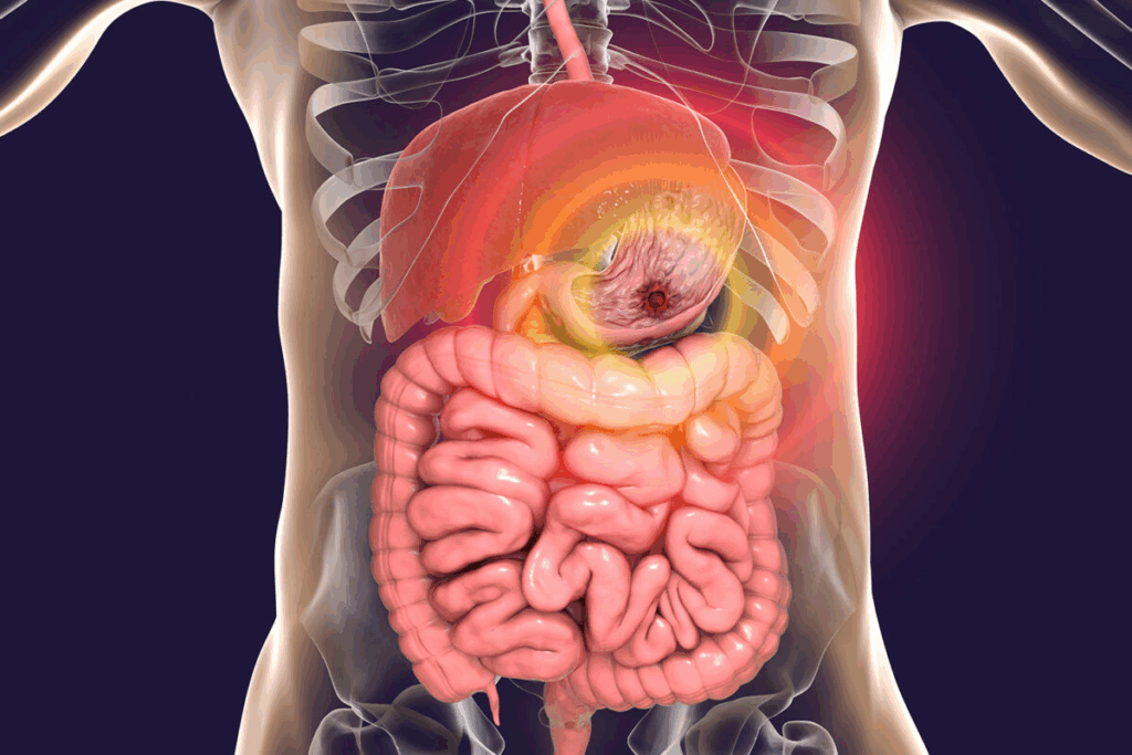 5 Critical Duodenal Switch Complications