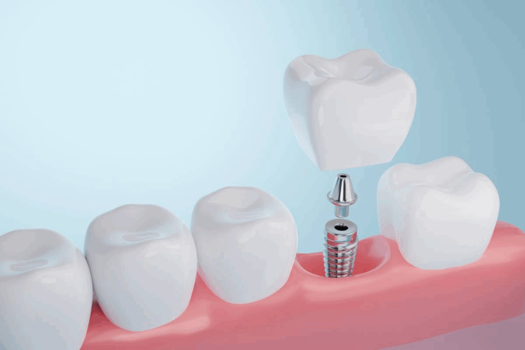Does The VA Cover Dentistry Denture And Implants For Veterans?
