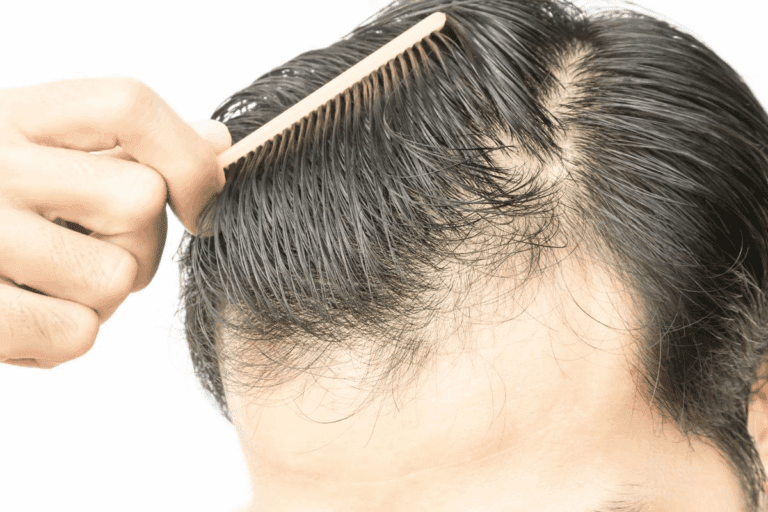 The Answer: Will My Hair Grow Back After Weight Loss?