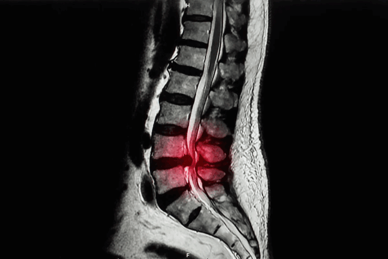 Spinal stenosis: Amazing neurosurgery solutions